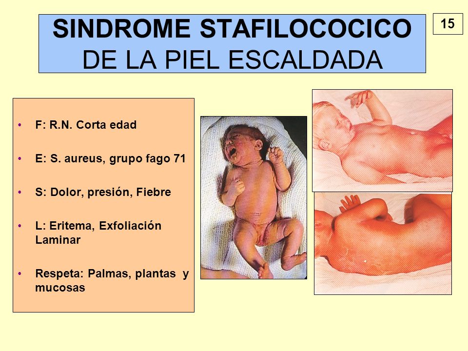 La psoriasis de que edad